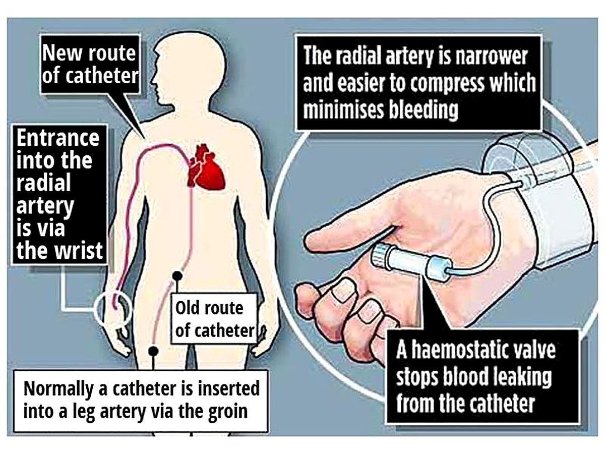 Coronary intervention visual