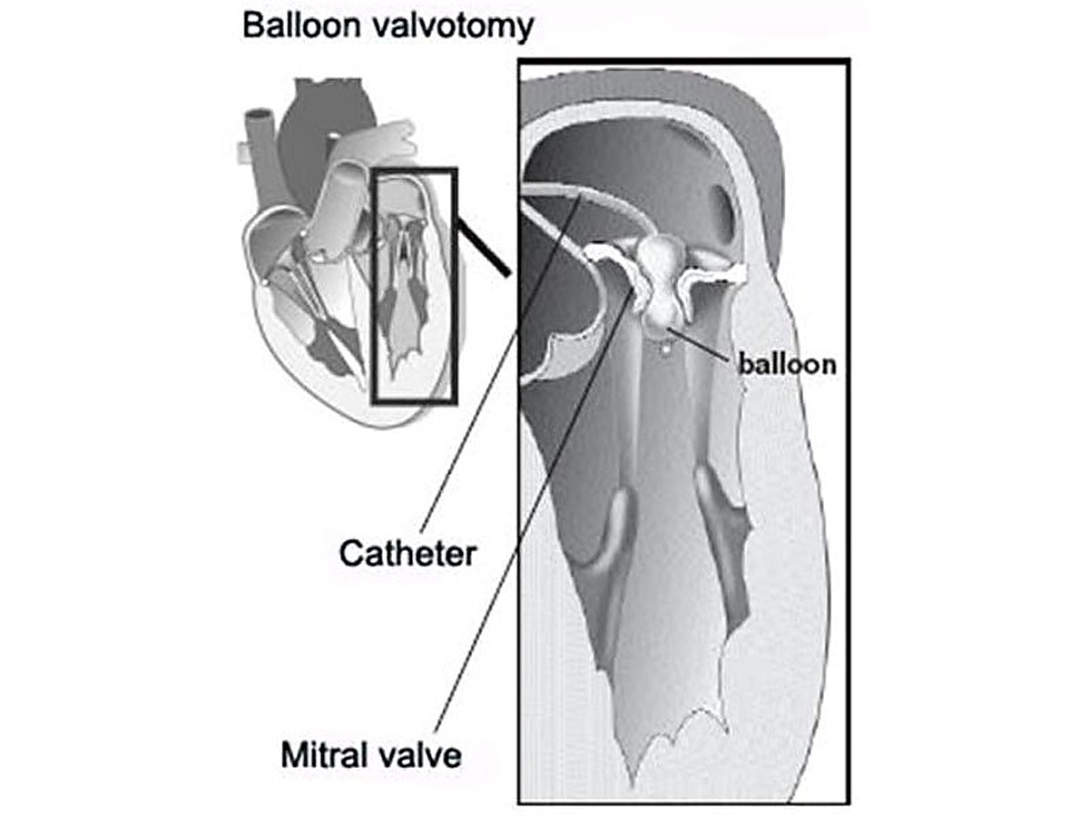 Structural heart treatment device visual